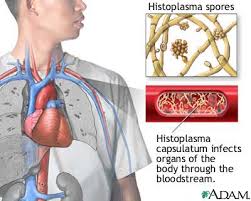 penyakit histoplasmosis